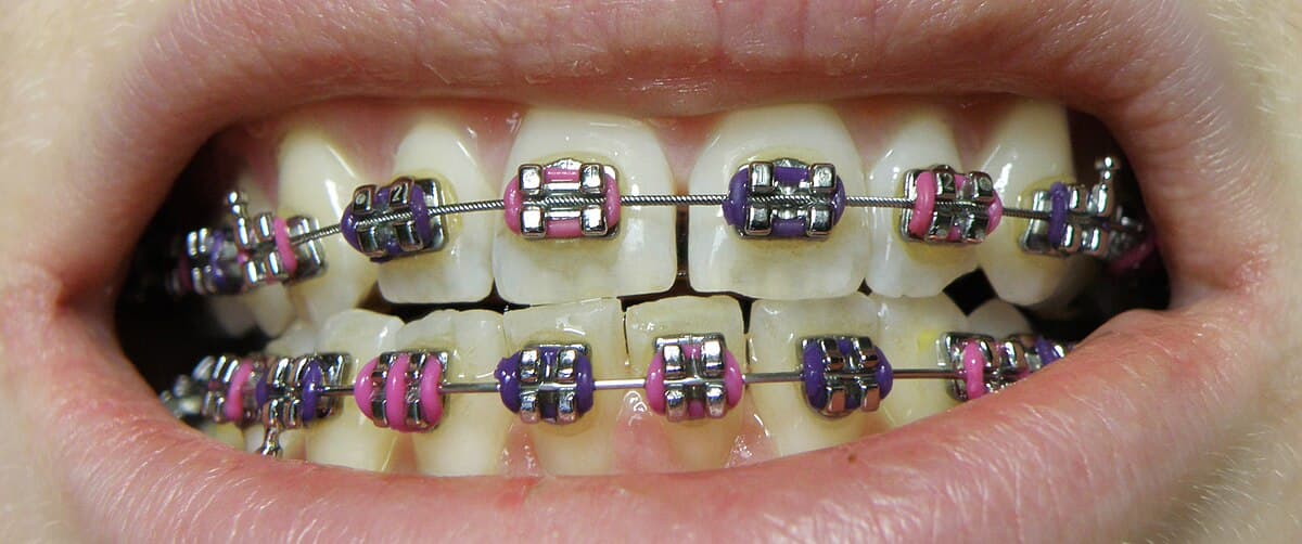 Bagues orthodontiques metalliques fixees sur les dents superieures et inferieures d'un adolescent