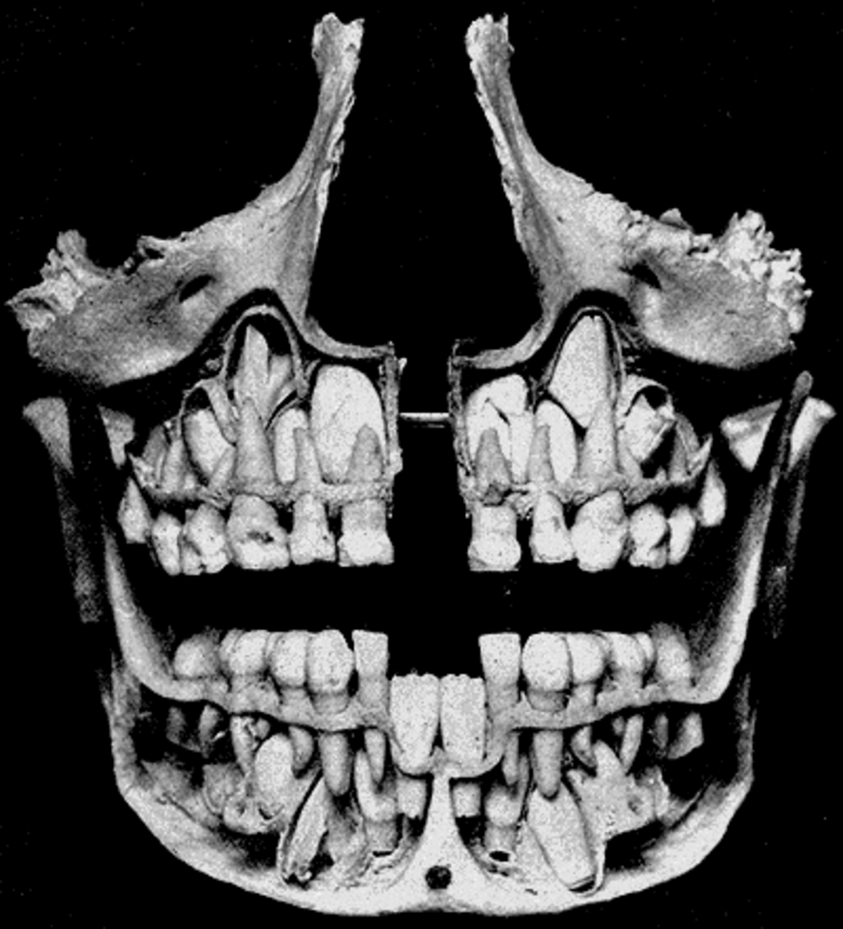 Coupe anatomique des machoires d'un enfant montrant les dents de lait et les germes des dents definitives